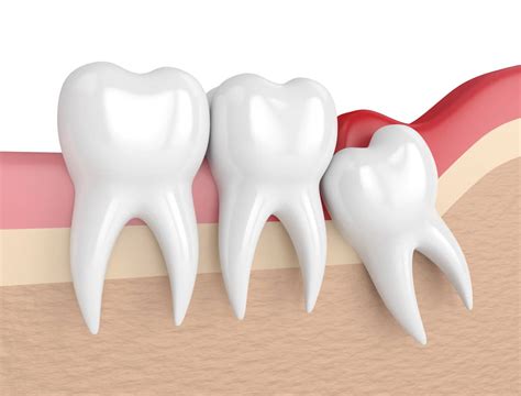 teeth shift after wisdom teeth removal - norine-apuzzi