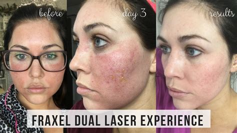 Acne Scar Treatment Norfolk, VA – Edgewater Aesthetics | The Premier Norfolk Med Spa