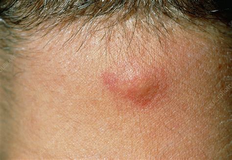 Sebaceous Cysts Are Small Bumps Or Bumps Under The Skin That Extend | Images and Photos finder