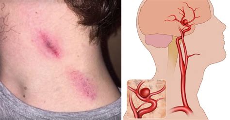 17-Year-Old Boy Dies From Seizure After THESE Marks Form On His Neck - DavidWolfe.com