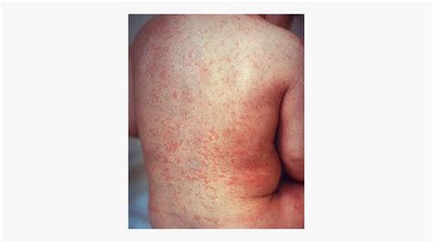 Rare Skin Diseases