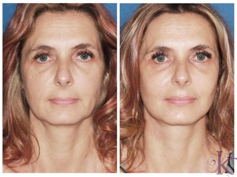 Mini Facelift Before and After Photo Gallery | New York, NY | Konstantin Vasyukevich, MD