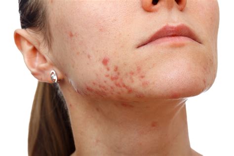 Acne Papules: Causes, Treatments, Natural Remedies, Do's and Don’ts