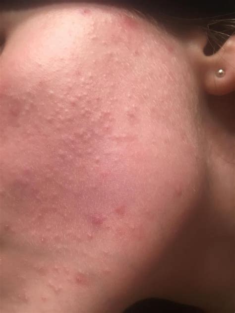 Small flesh colored bumps on cheeks - General acne discussion - Acne.org