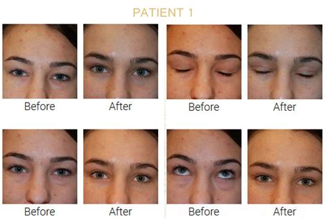 Before & After Pictures of Eyelid Surgery/Blepharoplasty | Plastic Surgeon NYC