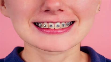 The Best Braces Colors: The Comprehensive Guide In 2023