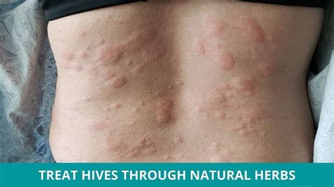 Stress Hives On Lips | Sitelip.org