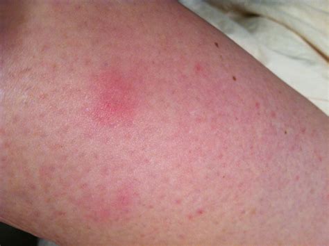 Small Red Spots On Skin Not Itchy | Images and Photos finder