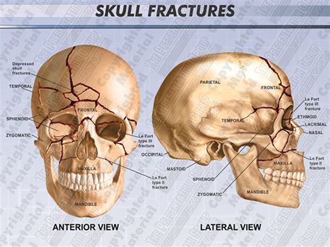 Skull Fracture Types