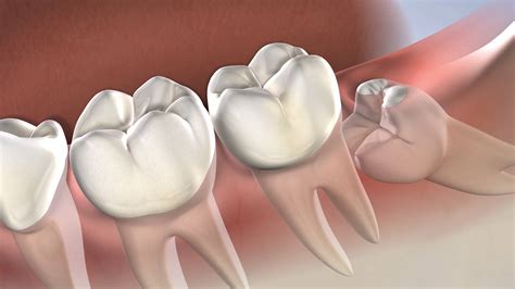 Symptoms that indicate Wisdom Teeth Removal Procedure