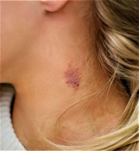 How To Give Yourself A Hickey On Your Neck? Fake Love Bites » Making ...