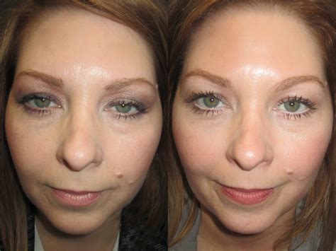 Droopy Eyelids Atlanta | Ptosis Surgery Decatur | OPAL Aesthetics Duluth