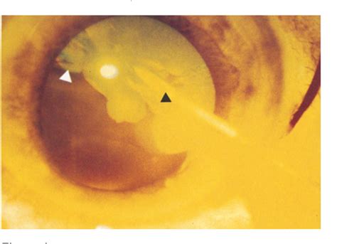 Hypermature cataract | Semantic Scholar