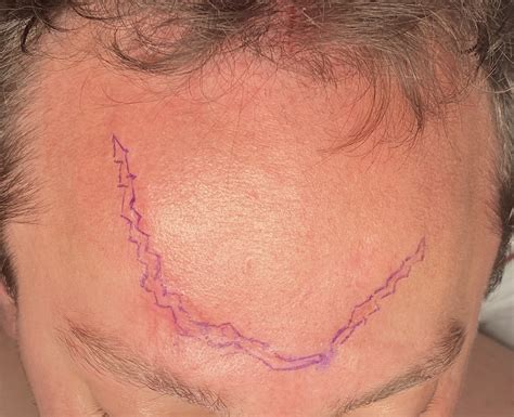 geometric forehead scar revision Dr Barry Eppley - Explore Plastic Surgery