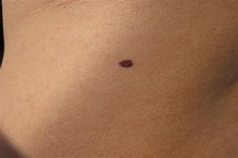 New moles and what to look out for - Medical News Corner