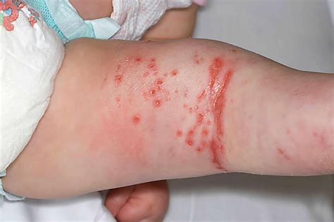 Common skin conditions in babies - Mayo Clinic Press