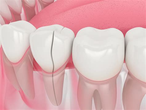 4 Ways to Fix a Cracked Tooth - Austin Laser Dentist - Helen Ragsdale DDS - Austin Dentist