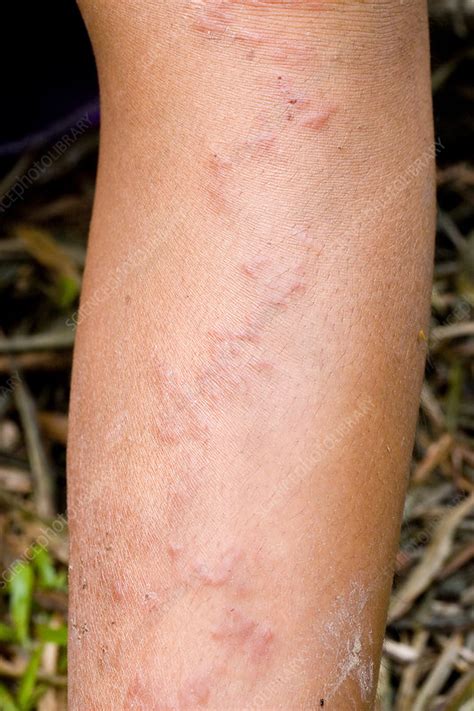 Cutaneous Larva migrans - Stock Image - M200/0254 - Science Photo Library