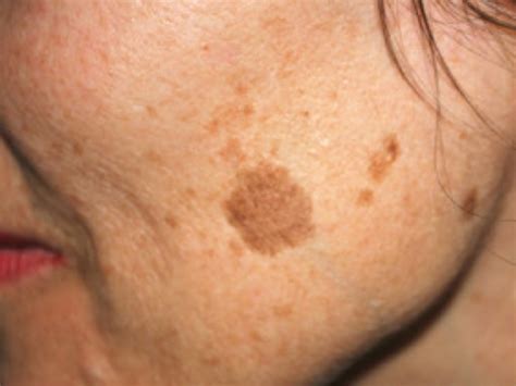 Age Liver Spots: Symptoms, Causes, Treatment Toronto Dermatology Centre ...