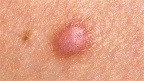 Hard Lump Under The Skin Causes And Pictures | Images and Photos finder