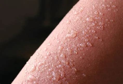 Sunburn (Sun Poisoning) Symptoms, Cancer, Treatment & Remedies