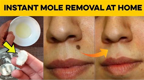 How To Remove Moles On Skin At Home - HOWTORMEOV