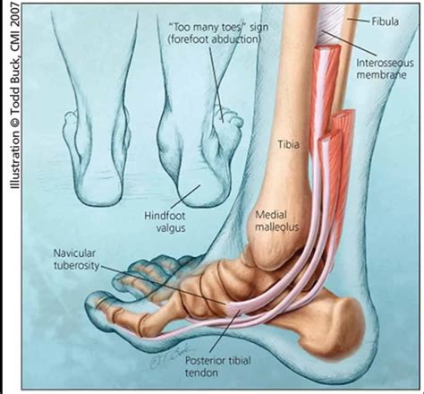 Dance Injuries - Posterior Tibial Tendonitis - BodyTree Ballet