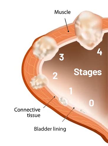 Bladder Cancer: Causes, Signs, Symptoms, Diagnosis and Stages | Saint John’s Cancer Institute ...