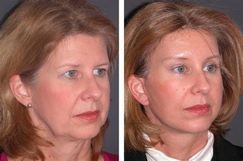 Lower Facelift | Best Lower Facelift Results in New York