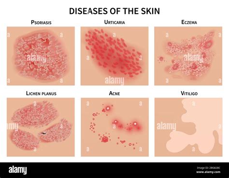 Skin diseases. Derma infection, eczema and psoriasis. Dermatology vector illustration. Disease ...