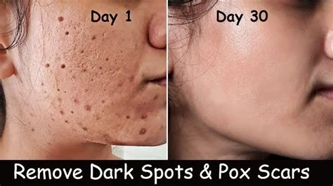 How To Get Rid Of Chicken Pox Scars Easily?