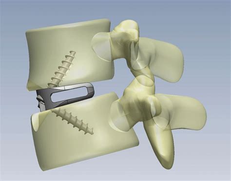 Anterior Lumbar Interbody Fusion (ALIF) — Betsy Grunch, MD