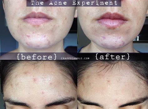 Aztec Healing Clay Mask Review - The Acne Experiment | Crappy Candle