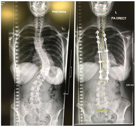 Before and after my scoliosis spinal fusion :) [OC] : XRayPorn