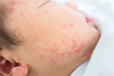 Pediatric Skin Conditions | Ogden Clinic