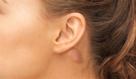 What You Need To Know About That Lump Behind Your Ear