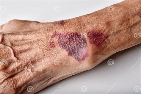 Bruise Wound on Senior People Wrist Arm Skin, Falls Injury Accident ...