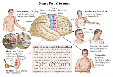 Dr Ajays Homeopathy : Homeopathy Approach to Epilepsy (seizure )