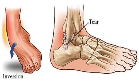 Ankle Sprains: Causes, Symptoms & Treatment, ankle sprain - mi-pro.co.uk