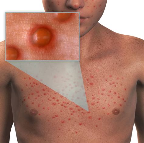 Adult Chicken Pox Stages