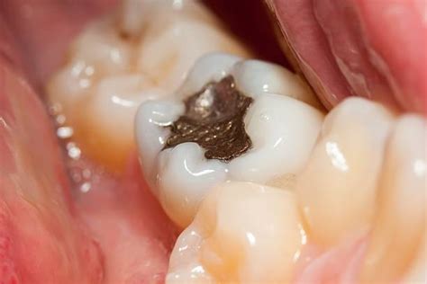 Do Cavity Fillings Hurt? - Web DMD