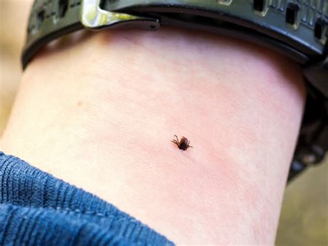 Tick bite rash – how to recognize the symptoms, treatment tips