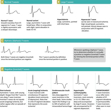 T-waves in ischemia: hyperacute, inversions (negative), Wellens sign ...