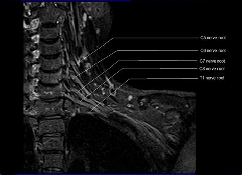 MRI Brachial Plexus Anatomy | Free MRI Coronal Cross Sectional Anatomy of the Brachial Plexus