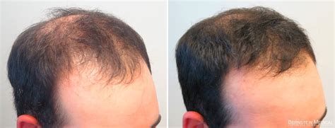 slsi.lk - how long for sulfatrim to work | Not take how to apply rogaine for receding hairline ...