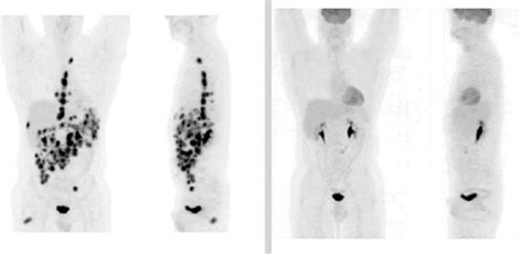 Pet Scan Images Of Lymphoma