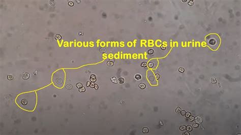 Dysmorphic Red blood cells under the Microscope - YouTube