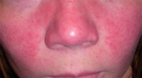 Lupus Rash – Pictures, Symptoms, Causes, Treatment | HubPages