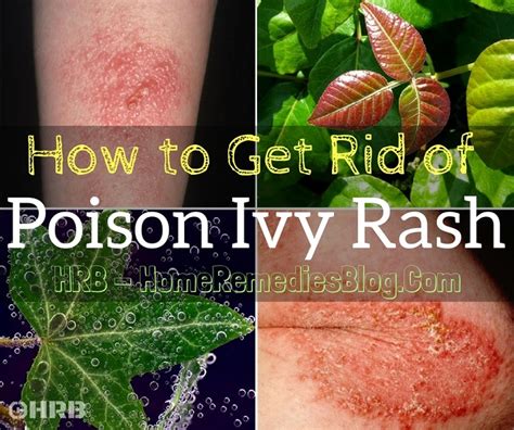 How to Get Rid of Poison Ivy Rash: 14 Fast Home Remedies - Home ...