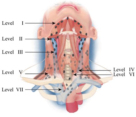 The system of lymph node levels in the neck, as described by Robbins et... | Download Scientific ...